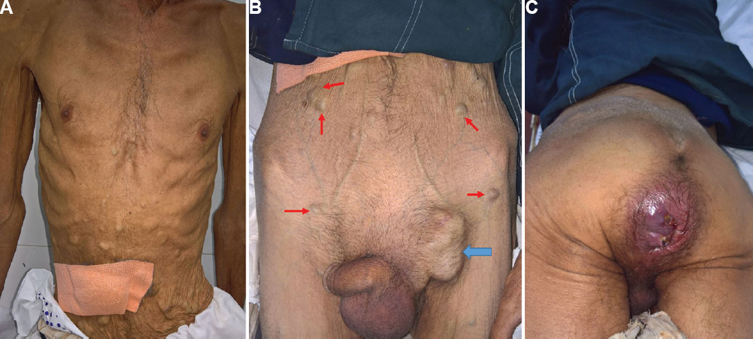 (A) Multiple bluish cutaneous nodules over anterior abdominal wall (red arrows). (B) enlarged left inguinal lymph nodes (blue arrows) and (C) ulcerated anal mass.